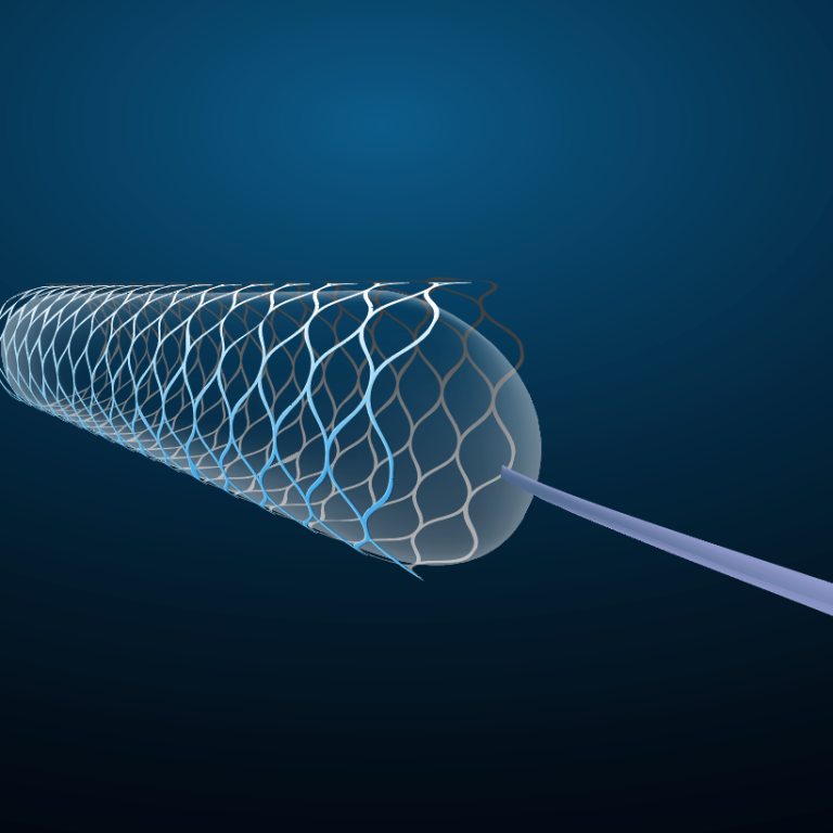 Stent. Koronare Herzkrankheit. Ich bin Expertin auf dem Gebiet der interventionellen Kardiologie und biete bei Indikation die minimal-invasiven Untersuchungen wie Koronarangiographie mit Stentimplantation an.